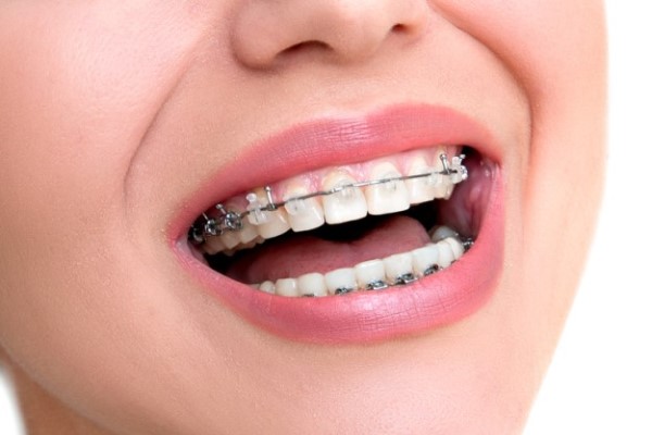 What To Ask Your General Dentist About Clear Braces For Teeth Straightening