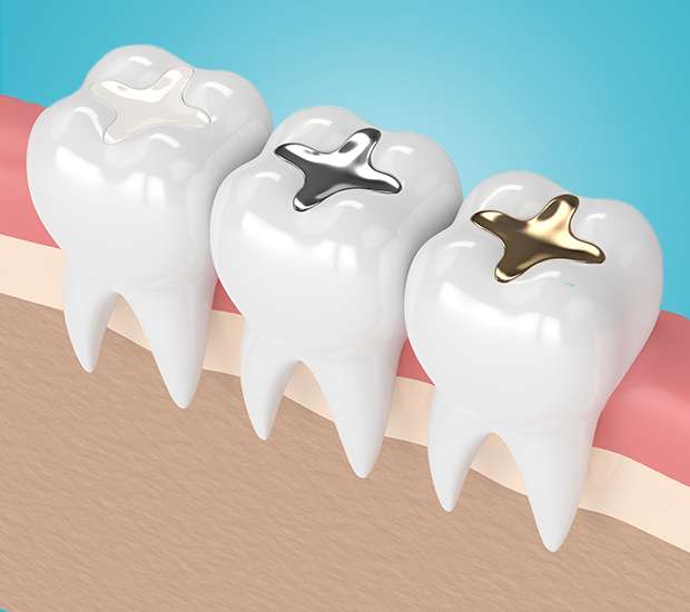 Chamblee Composite Fillings