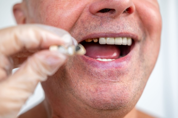 Alternatives To Dental Crowns: Exploring Other Dental Restoration Options