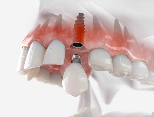 Dental Implant Chamblee, GA