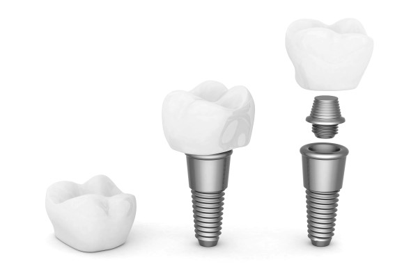 How Long Do Dental Implants Crowns Last?