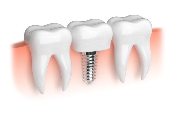 Missing A Single Tooth? Consider A Dental Implant