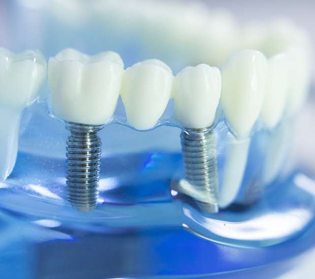 Chamblee Dental Implants