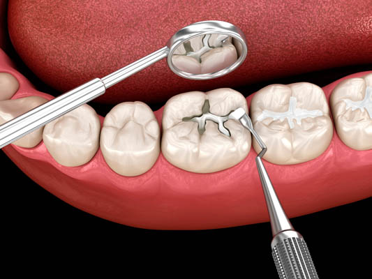 Reasons You Might Need A Dental Inlay