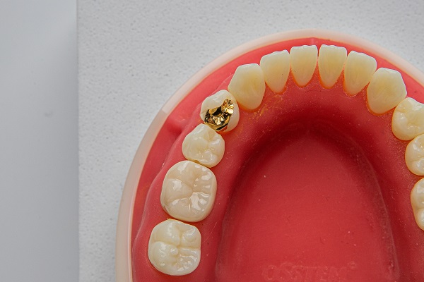 A Step By Step Guide To Getting A Dental Inlay