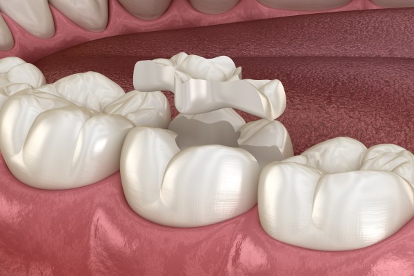 Is A Dental Inlay The Same As A Filling?