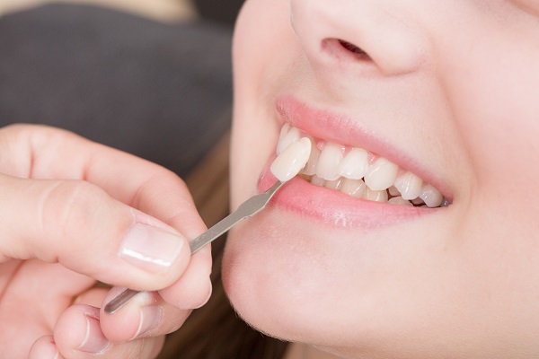 Important Things To Know Before Getting Dental Veneers