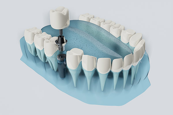 How Easy Is It To Replace An Implant Crown?