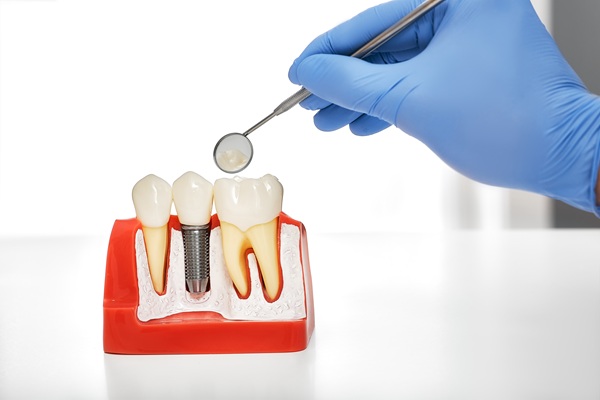 Implant Crowns Vs  Traditional Crowns: What Patients Should Understand
