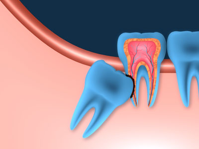 What You Should Know About Wisdom Teeth Removal In Chamblee